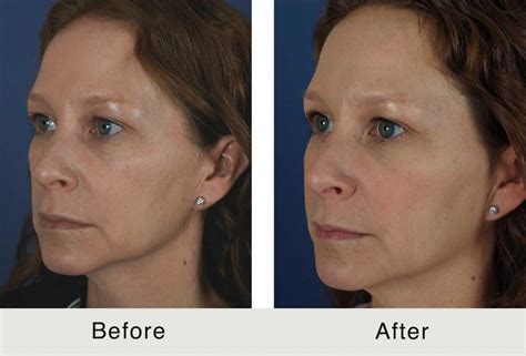 dr tamplen|Tamplen Plastic Surgery – Facelift.